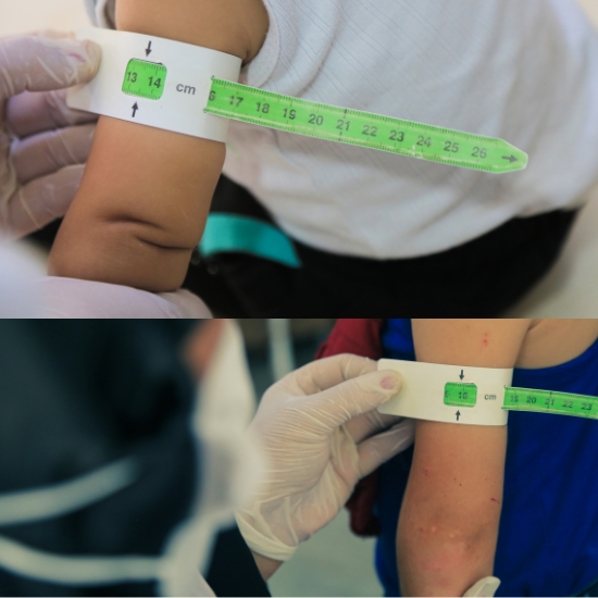 القضاء على النحافة وامراض سوء التغذية للاطفال والكبار